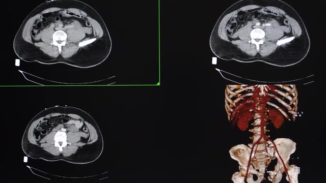 Whole abdomen CT of a traumatized male patient showing marked widening of pubic symphisis with fracture of lateral superior and inferior pubic rami.  Hematoma at bilateral pelvic side walls. 