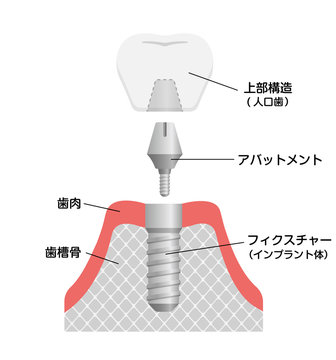 インプラント治療 Photos Royalty Free Images Graphics Vectors Videos Adobe Stock インプラント治療 Photos Royalty Free Images Graphics Vectors Videos Adobe Stock