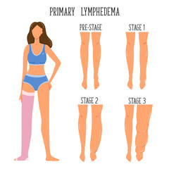 Primary Lymphedema stages. Lymphatic system disfunction. Elephantiasis, legs swelling disease. Young girl wearing compression stocking. - 348532020
