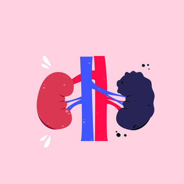 Healthy And Unhealthy Kidneys Vector Illustration. Kidney Infection
Drawing. Urolithiasis, Fibrosis Hand Drawn Concept.