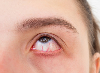 Fototapeta na wymiar Close up red eye of teenage girl with conjunctivitis or allergies