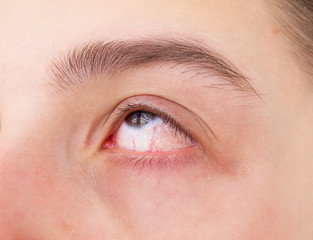 Fototapeta na wymiar Close up red eye of teenage girl with conjunctivitis or allergies