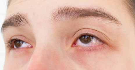 Obraz premium Close up red eyes of teenage girl with conjunctivitis or allergies