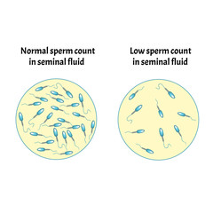 Low sperm count in seminal fluid. Low abundance of sperm in the ejaculate. Male infertility Oligospermia. Spermogram. pathology types. Sperm defects. structure of the sperm. Infographics Vector.