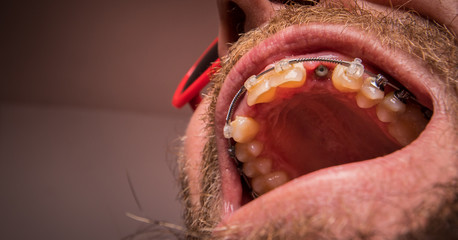 Macro shot of a two installed implants in a human mouth. Closed healing implant on left and open...