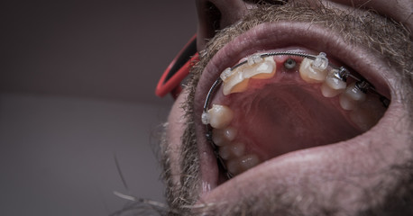 Macro shot of a two installed implants in a human mouth. Closed healing implant on left and open healing implant on on right surrounded by gums and healing tissue.  Visible nut of an implant in jaw