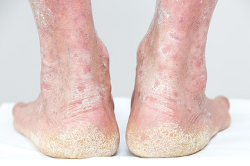 Acute psoriasis on male legs and heels is an autoimmune incurable dermatological skin disease....