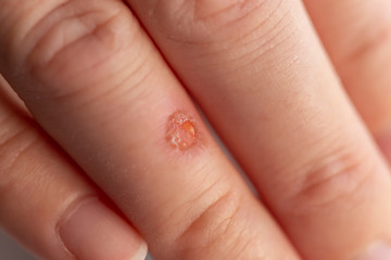 Fresh round shaped wound on a finger