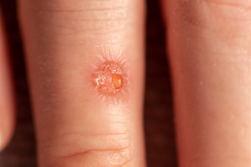 Open hand wound with leaking exudate while healing