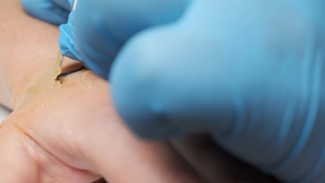 microchipping human. microchip is implanted under skin on man hand close-up. 