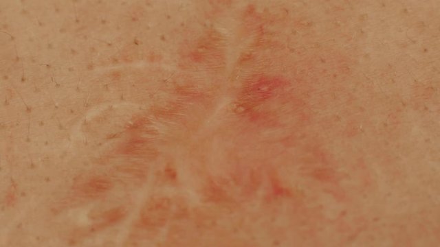 A scar on a person s skin, macro. Scar healing agents, background, medical