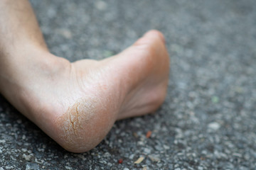 cracked heels in men on asphalt road.