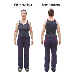 The 18 tender or trigger points of fibromyalgia indicated by red spots on the body of an woman,...