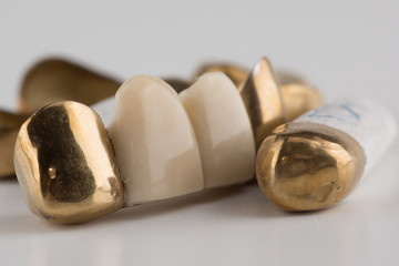 stamped brazed dental bridges