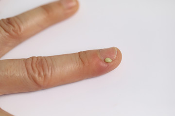 Finger swollen with inflammation due to Nail ripped infection, Finger with pus next to fingernail called Paronychia