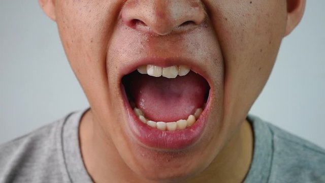 Close up face of Asian teenage guy with a problem of abnormal tooth structure. Health and oral care concepts.
