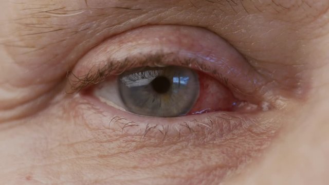 Cataract surgery infection on eye extreme closeup