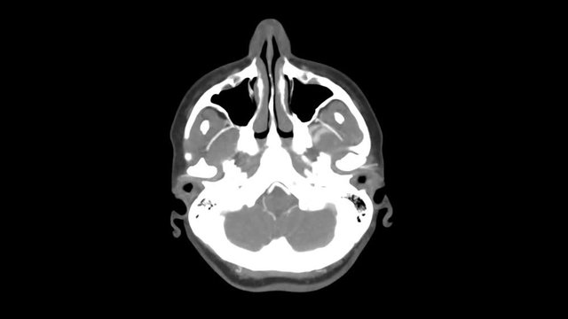 MIP Reconstruction Displaying Computed Tomographic Angiography Of A Human Brain's Axial Anatomy - closeup shot