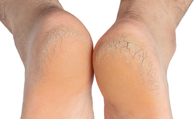 Men's feet with dry heels, cracked skin ,On a white background