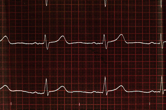 Close up of an electrocardiogram in paper form. Medical healthcare concept. ECG
