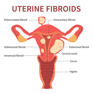 Isolated flat vector illustration of uterine fibroids, myoma, uterine leiomyomas on white background mentioning pedunculated, intracavitary, submucosal, subserosal.