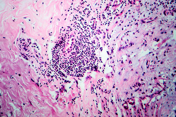 Breast fibroadenosis, light micrograph