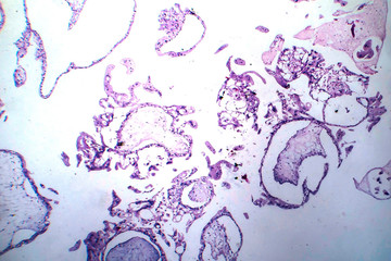 Hydatiform mole, light micrograph