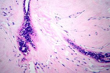 Uterus adenofibroma, light micrograph