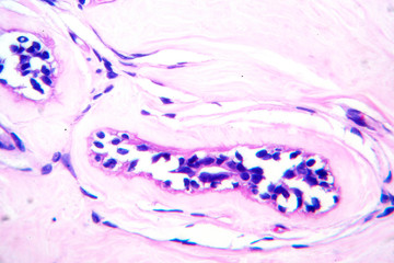 Uterus adenofibroma, light micrograph
