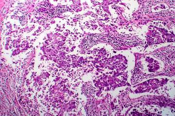 Breast ductal carcinoma, light micrograph