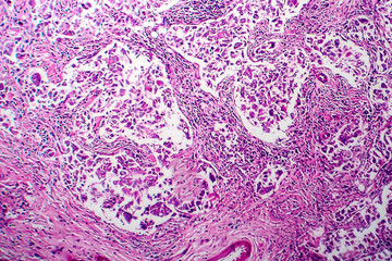 Breast ductal carcinoma, light micrograph