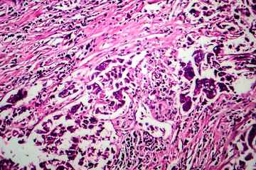 Breast ductal carcinoma, light micrograph