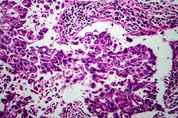 Breast ductal carcinoma, light micrograph