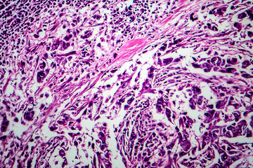 Breast ductal carcinoma, light micrograph