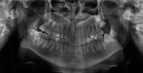 Dental x-ray of a mouth
