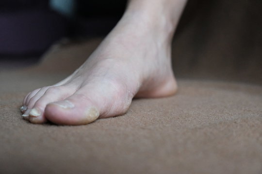 Warts corns on woman foot sole before appointment with a dermatologist.brown background.