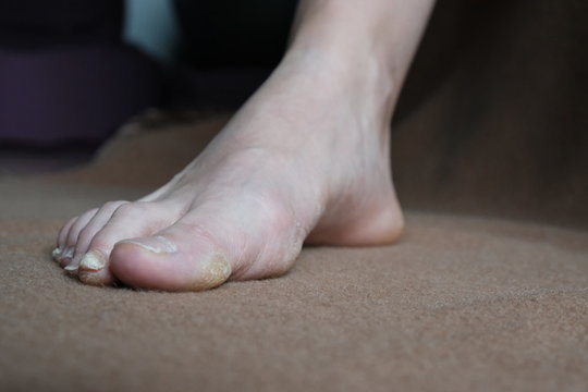 Warts corns on woman foot sole before appointment with a dermatologist.brown background.