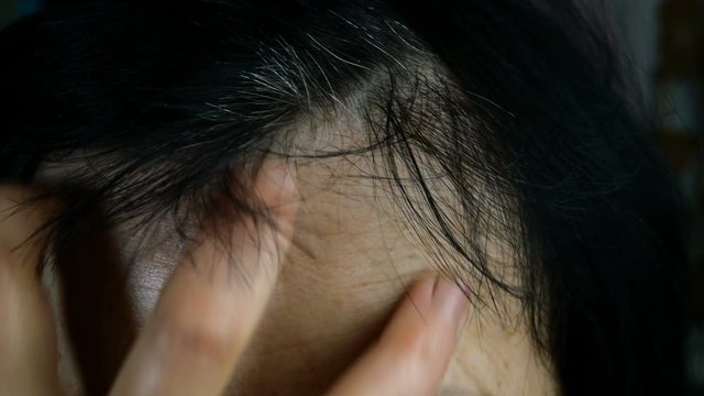 Mature adult woman removes hair from her forehead. Gray hair, alopecia and problematic skin on the head. Close-up. Indoors.
