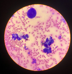 Atypical cells in body fluid smear.