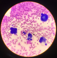 Atypical cells in body fluid smear.
