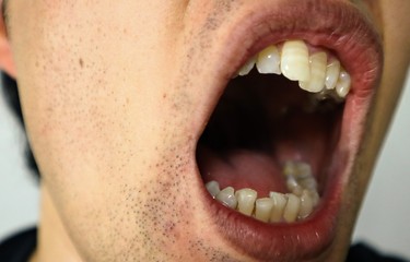 歯並びが悪い男性のクローズアップ