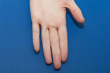 Treatment with acupuncture needles. Human hand