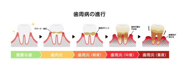 歯肉炎 歯周病のステージと症状イラスト Wall Mural Barks