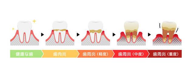 歯肉炎・歯周病のステージと症状イラスト