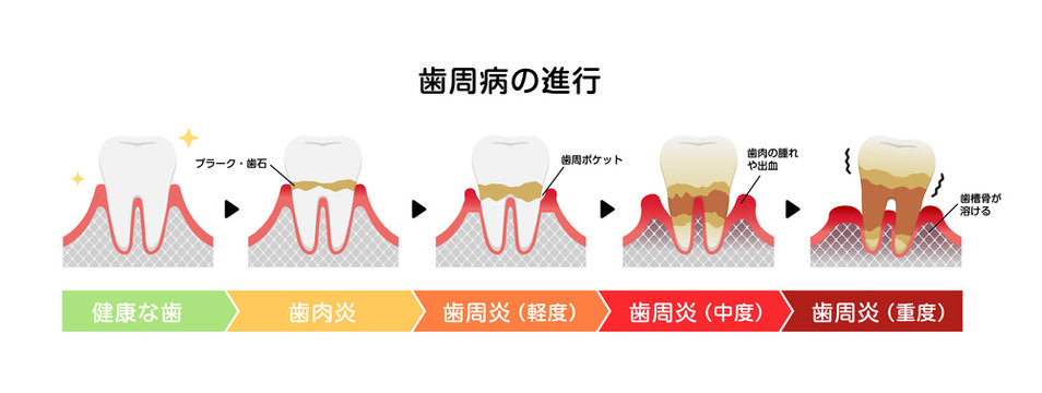 歯肉炎 Images Browse 1 496 Stock Photos Vectors And Video Adobe Stock