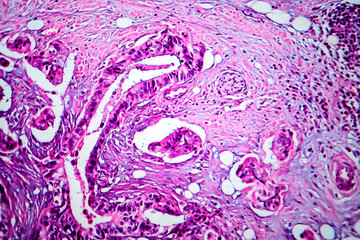 Breast cancer, light micrograph