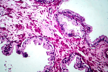 Prostate cancer, light micrograph