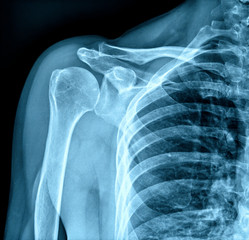 Photo of x-ray human shoulder