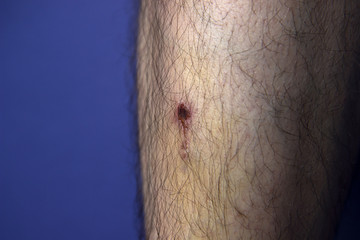 bruise and clotted blood on the leg of a young man