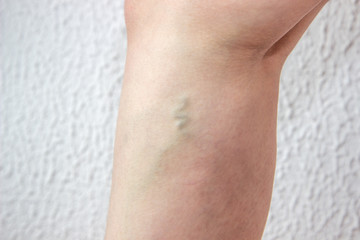 varicose veins on a woman leg, a node under the knee